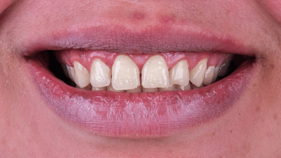 علاج وتجميل اللثة — بعد
