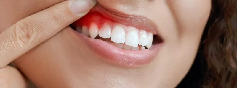 لماذا من المهم معرفة اسباب التهاب اللثة​؟