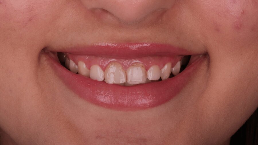 علاج وتجميل اللثة — قبل