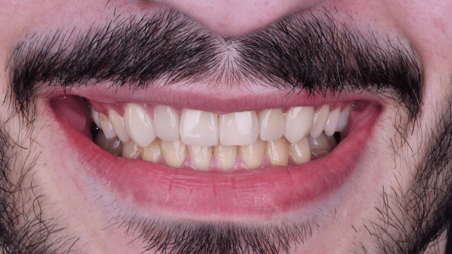 الحشوات التجميلية — بعد