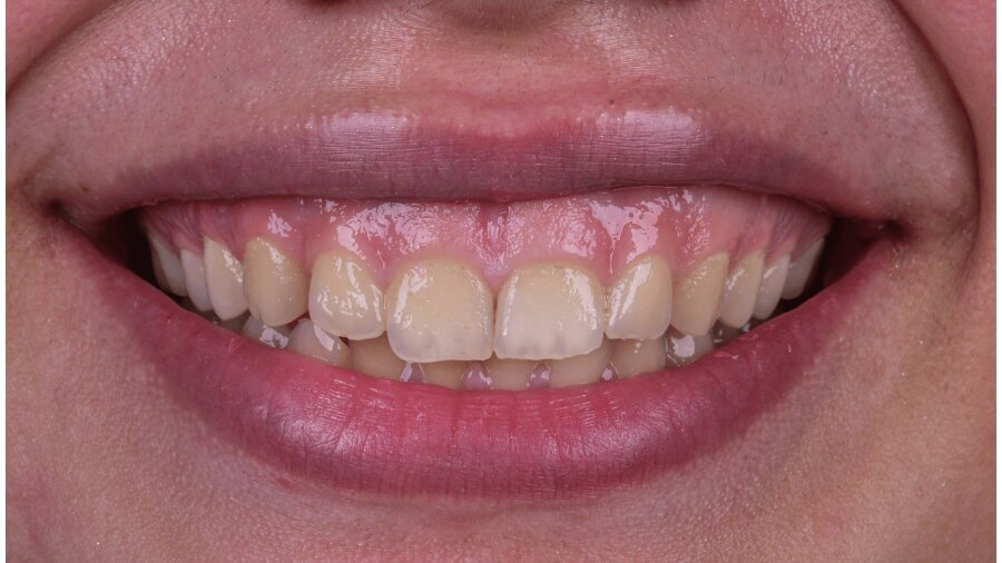 علاج وتجميل اللثة — قبل