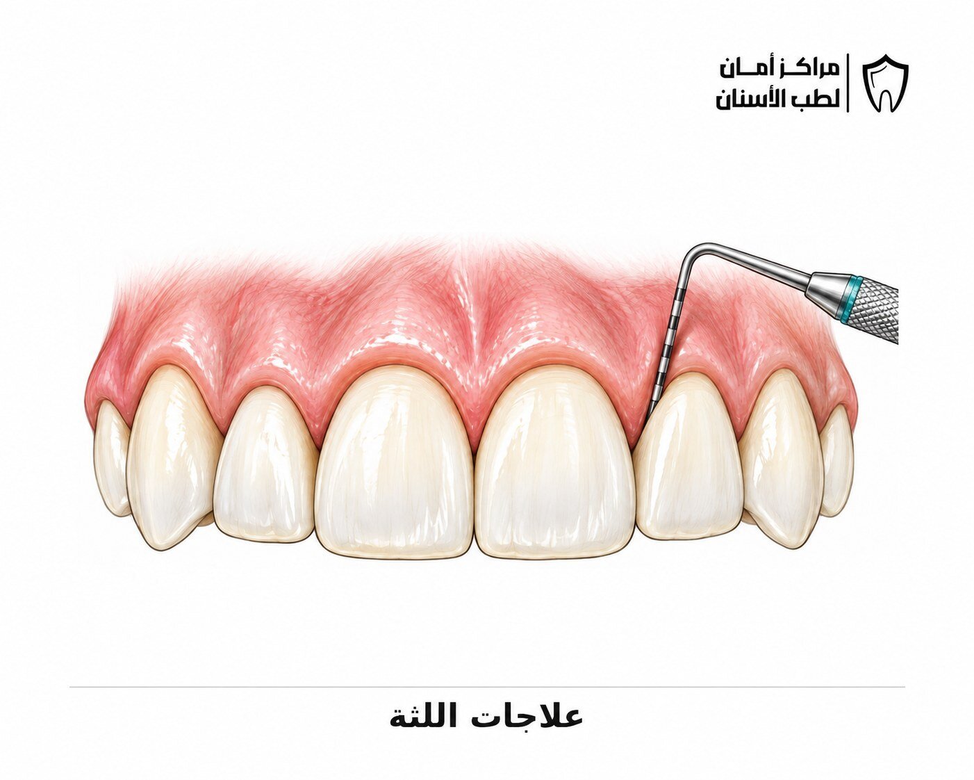علاج وتجميل اللثة