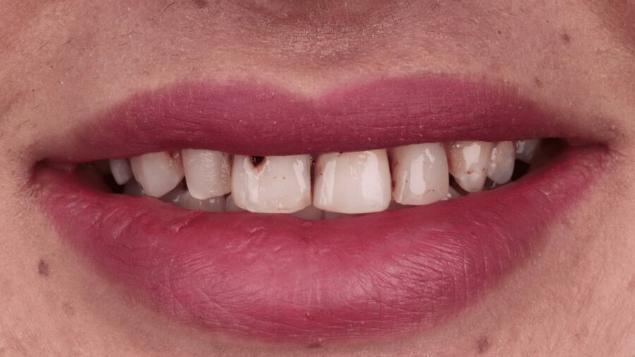 الحشوات التجميلية — قبل