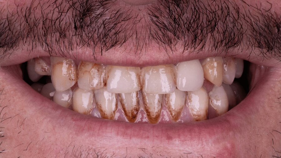 الحشوات التجميلية — قبل