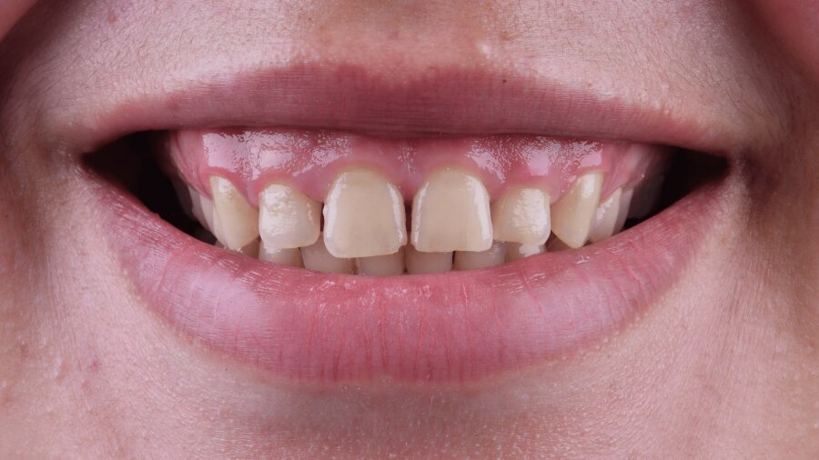 علاج وتجميل اللثة — قبل