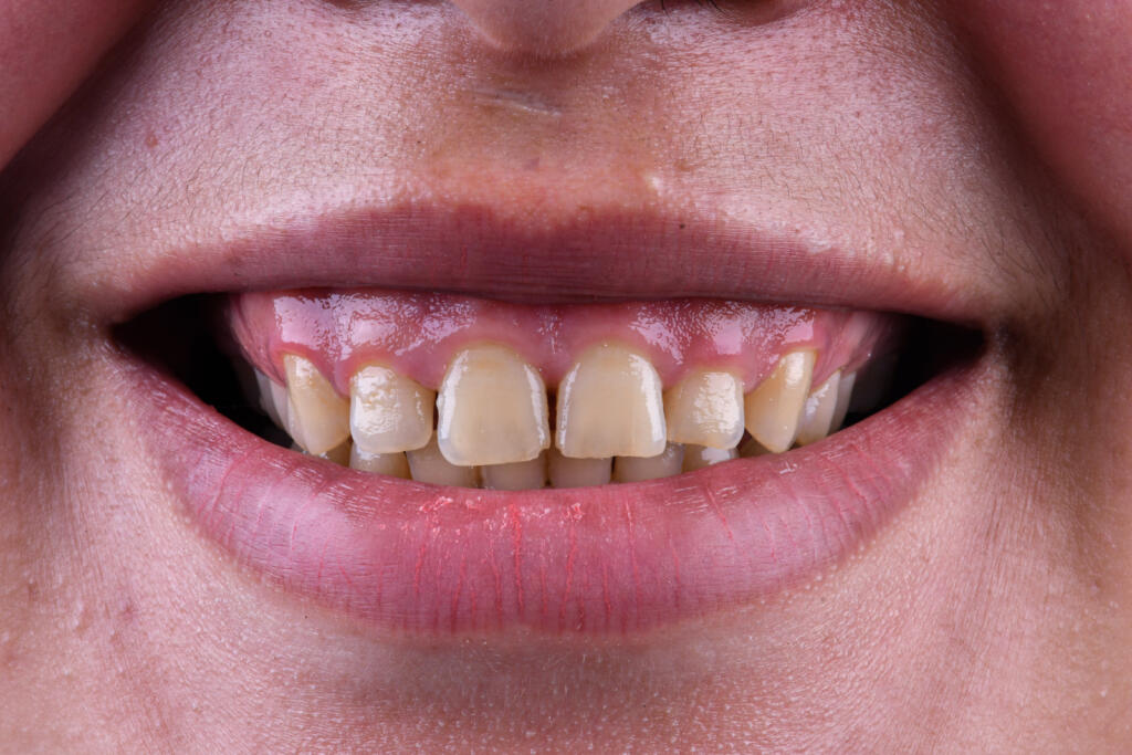 أعراض التهاب اللثة