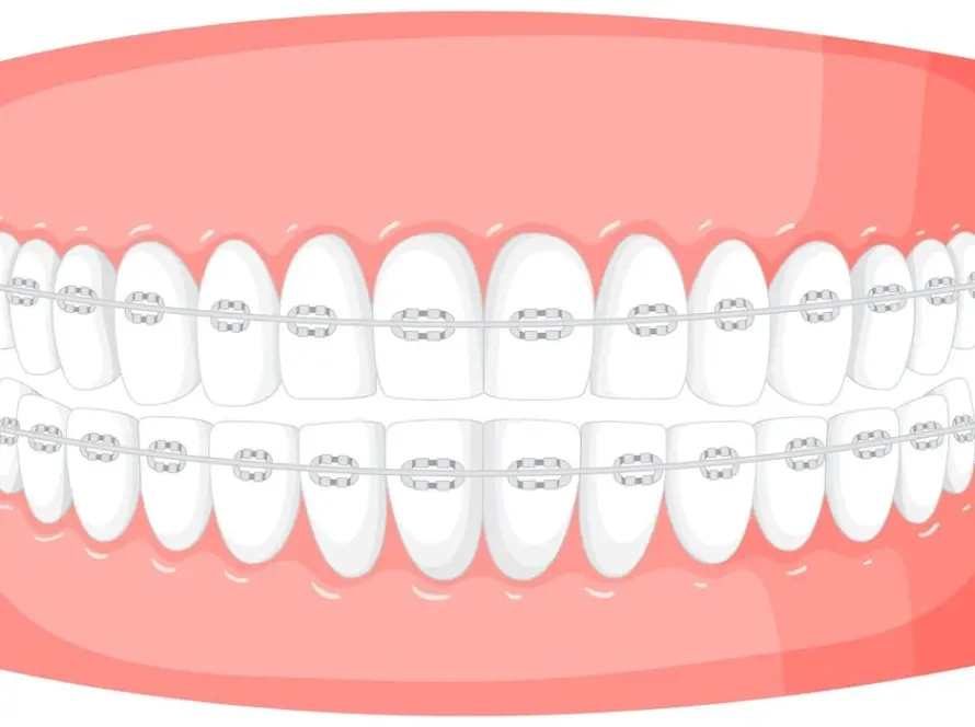 تقويم الاسنان