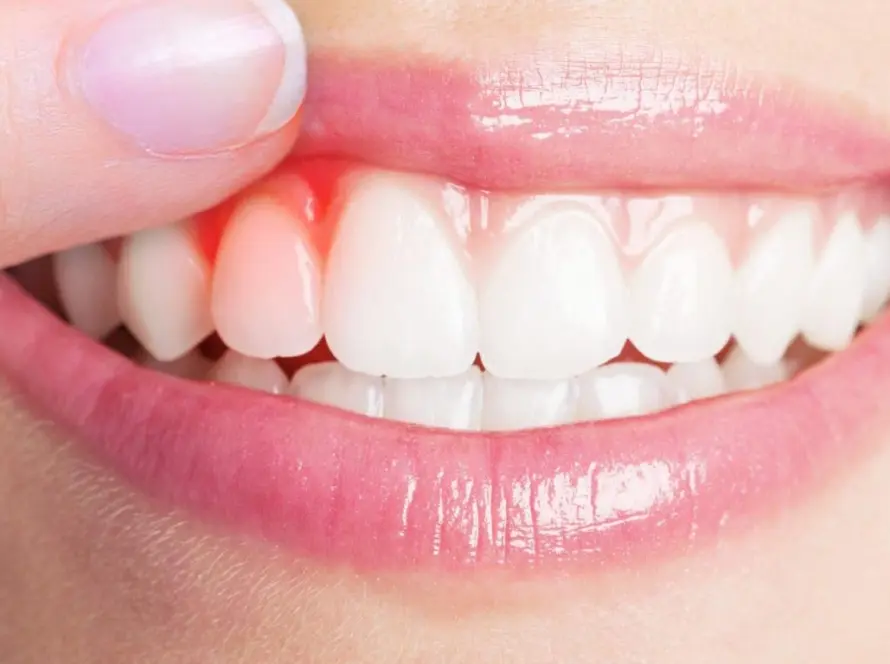 اسباب التهاب اللثة