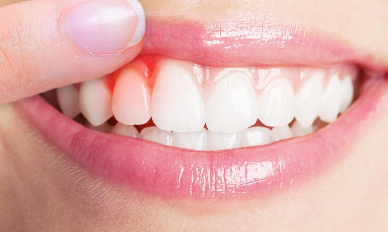 اسباب التهاب اللثة