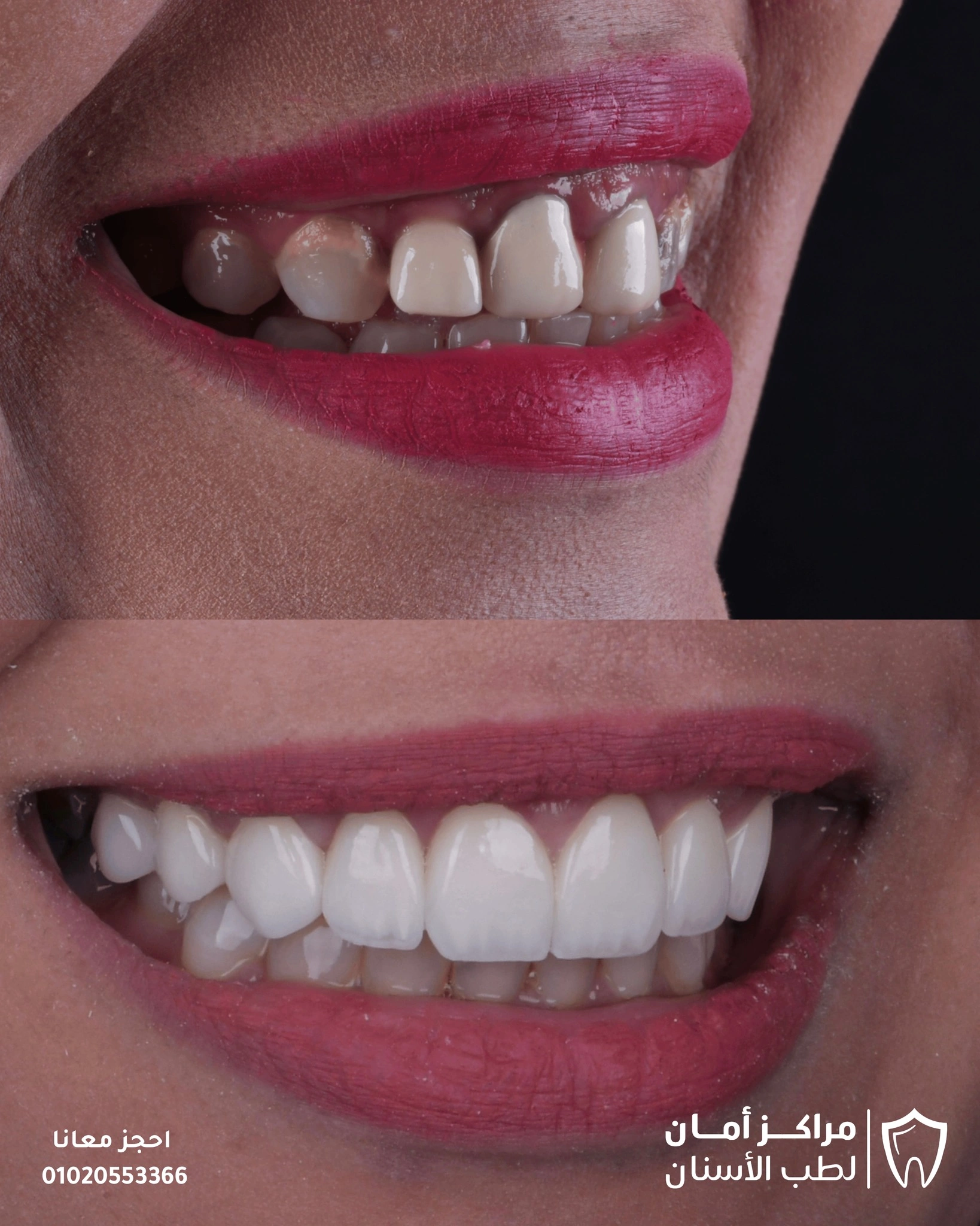 سعر تقويم الاسنان في مصر