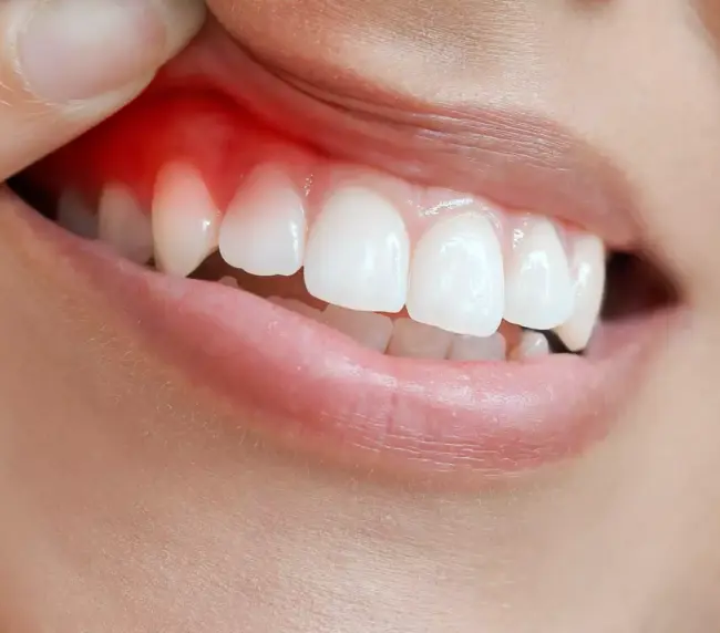 انواع زراعة الاسنان الالمانية