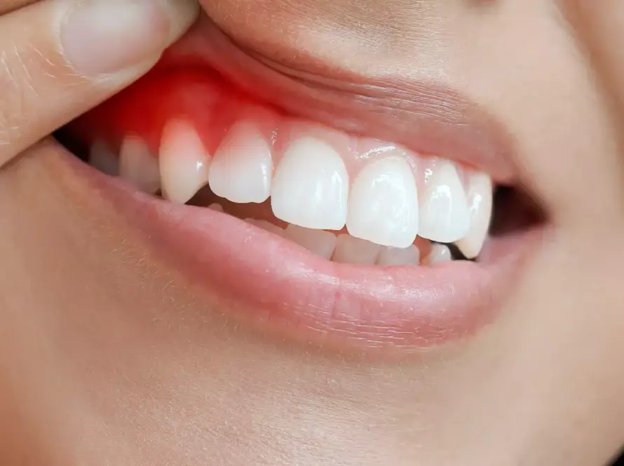 انواع زراعة الاسنان الالمانية