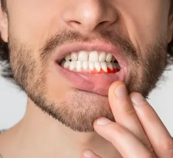 أعراض التهاب اللثة