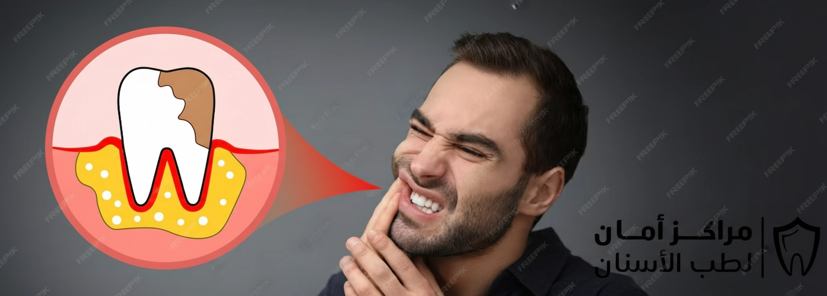 علاج التهاب اللثة وانتفاخها في المنزل