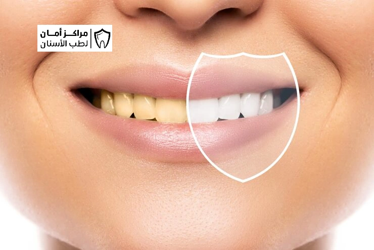 ما الفرق بين الفينير واللومينير؟