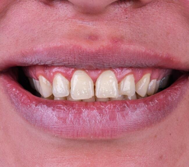 Close-up photograph of teeth and gums