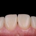 Veneers in Egypt: costs, treatment planning and aftercare