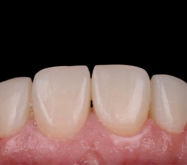 Clinical photograph showing restored front teeth