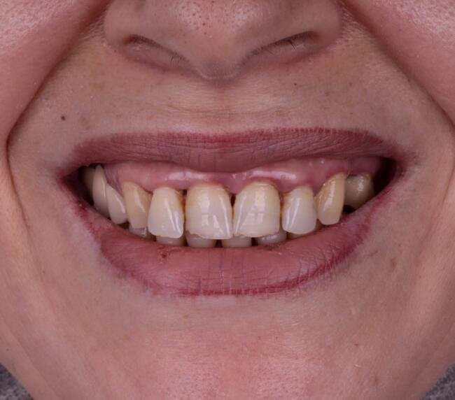Photograph of a smile and natural teeth