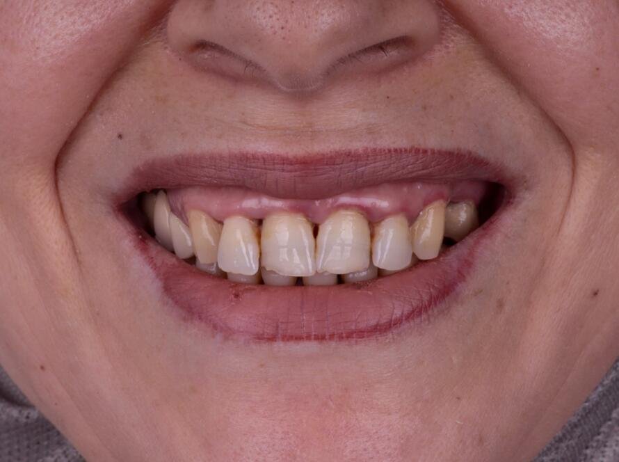 Photograph of a smile and natural teeth